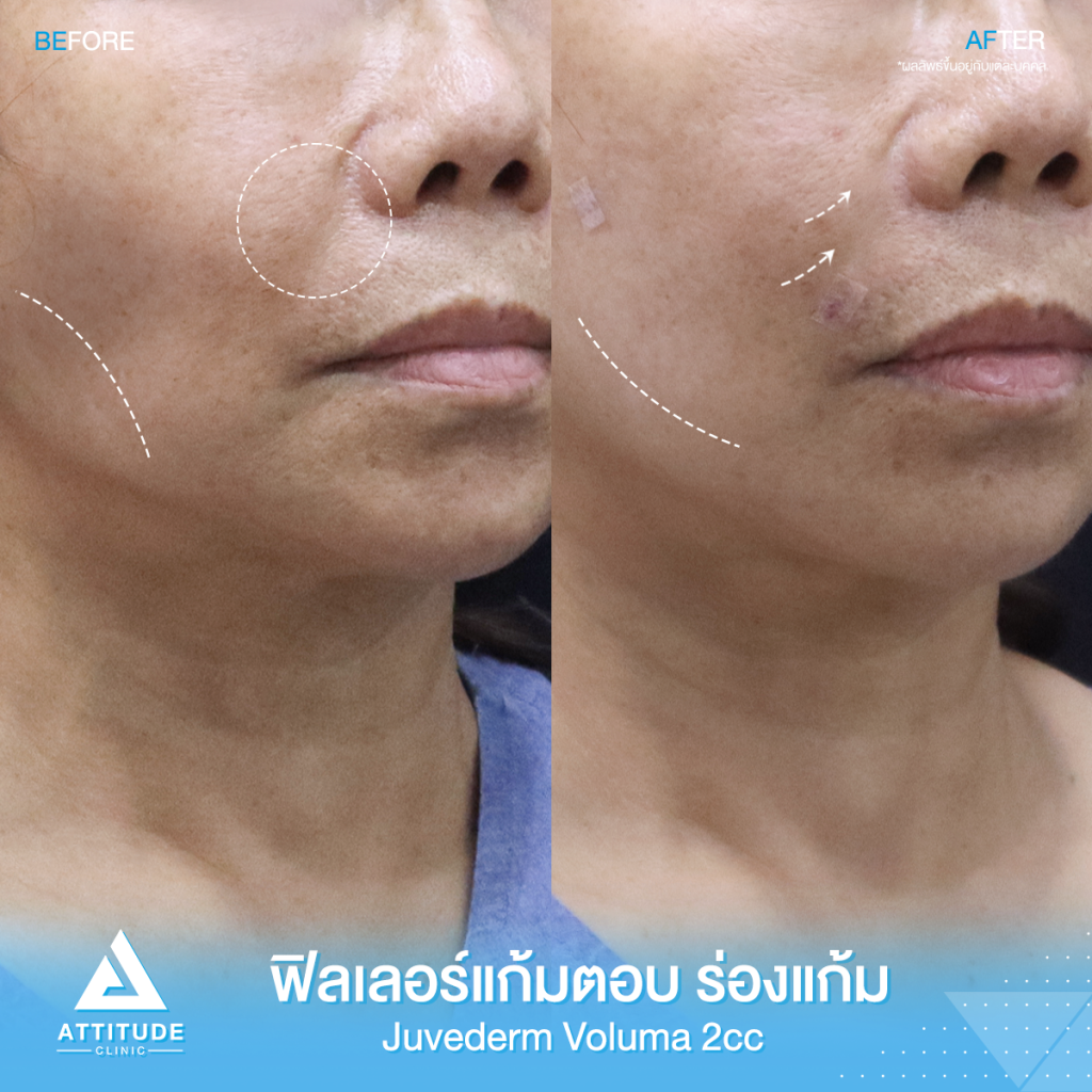 เติมร่องแก้ม แก้มตอบเต็มทันที! รีวิวฉีดฟิลเลอร์ ร่องแก้ม แก้มตอบ Jeuvederm Voluma จำนวน 2 cc เติมเต็มร่องลึกให้อิ่มฟู หน้าเด็กลง หน้าโดยรวมมีมิติมากขึ้น มั่นใจ ด้วยฟิลเลอร์แท้