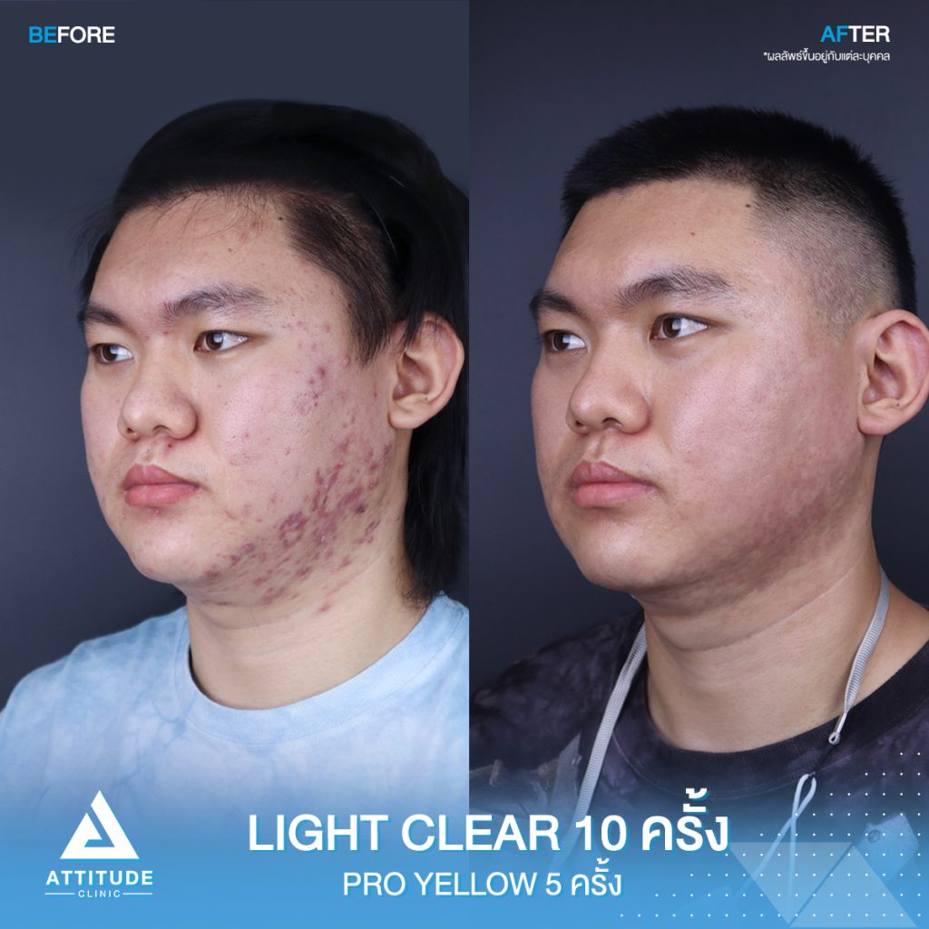 รีวิวรักษาสิวด้วยการฉายแสง สิวหาย หน้าใสวิ้ง เชื่อใจแอททิจูด รีวิวรักษาสิวด้วยการฉายแสง 7 ขั้นตอน โปรแกรม Light Clear จำนวน 10 ครั้ง และเลเซอร์ Pro Yellow ลดรอยแดงโดยเฉพาะ จำนวน 5 ครั้ง ของน้องสมบูรณ์