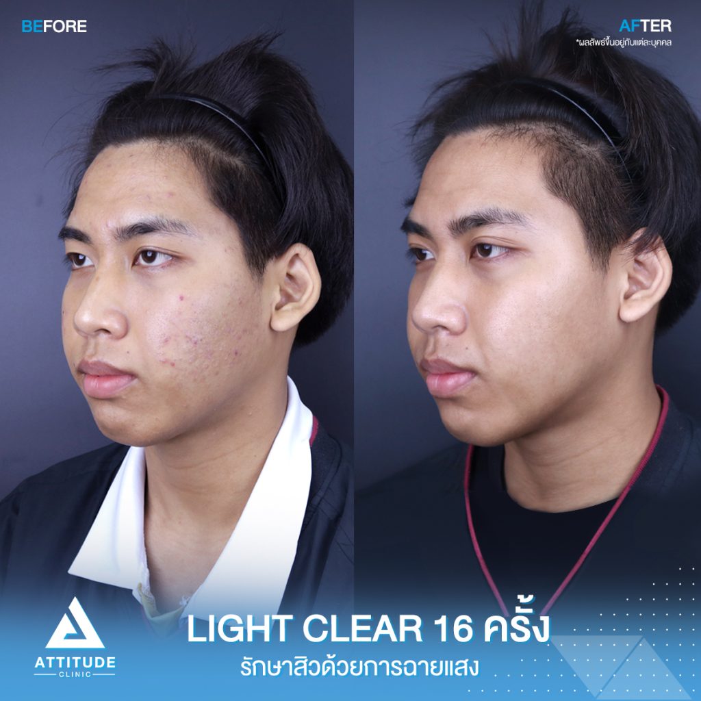 สิว! รอยสิว! หายได้ที่แอททิจูด รีวิวรักษาสิวด้วยการฉายแสงโปรแกรม Light Clear 7 ขั้นตอน จำนวน 16 ครั้ง ของน้องนนท์ ที่มีปัญหาสิวและรอยสิวจัดเต็ม หลังรักษาตอนนี้หน้าใส ผิวเรียบเนียน มั่นใจขึ้นสุดๆ