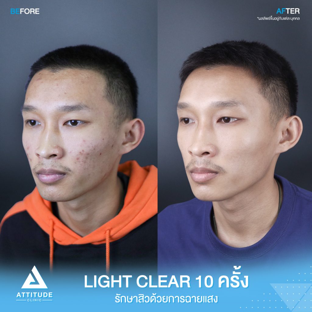 เปลี่ยนหน้าสิวเป็นหน้าใส รีวิวรักษาสิวด้วยการฉายแสง โปรแกรม Light Clear 7 ขั้นตอน จำนวน 10 ครั้ง น้องภัครพงษ์ มีปัญหาสิวและรอยสิวจัดเต็ม หลังรักษาสิวตอนนี้หน้าใสขึ้น ผิวเรียบเนียน มั่นใจขึ้นสุดๆ