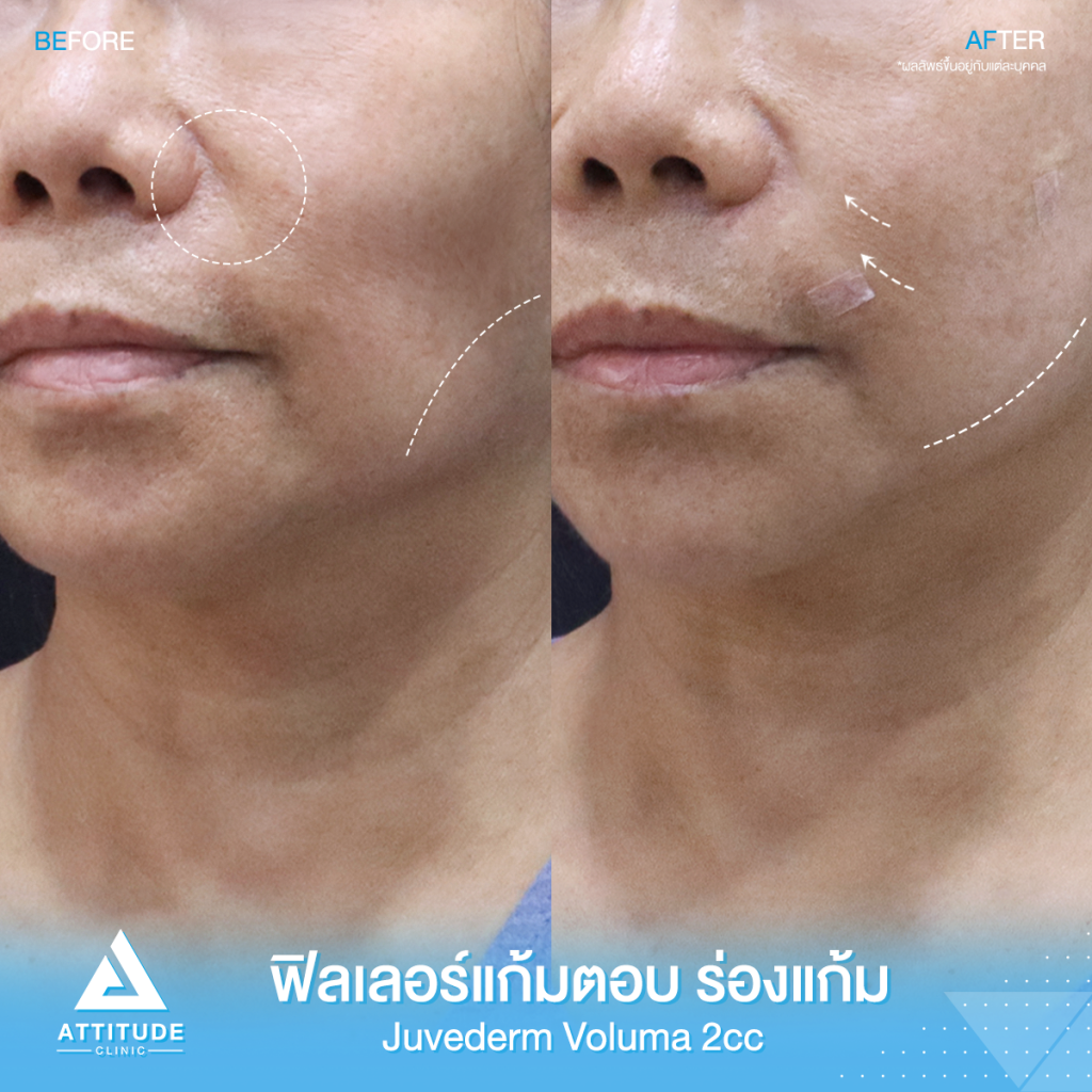 เติมร่องแก้ม แก้มตอบเต็มทันที! รีวิวฉีดฟิลเลอร์ ร่องแก้ม แก้มตอบ Jeuvederm Voluma จำนวน 2 cc เติมเต็มร่องลึกให้อิ่มฟู หน้าเด็กลง หน้าโดยรวมมีมิติมากขึ้น มั่นใจ ด้วยฟิลเลอร์แท้