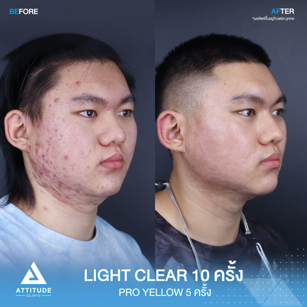 รีวิวรักษาสิวด้วยการฉายแสง สิวหาย หน้าใสวิ้ง เชื่อใจแอททิจูด รีวิวรักษาสิวด้วยการฉายแสง 7 ขั้นตอน โปรแกรม Light Clear จำนวน 10 ครั้ง และเลเซอร์ Pro Yellow ลดรอยแดงโดยเฉพาะ จำนวน 5 ครั้ง ของน้องสมบูรณ์
