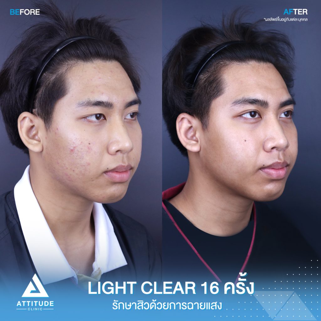 สิว! รอยสิว! หายได้ที่แอททิจูด รีวิวรักษาสิวด้วยการฉายแสงโปรแกรม Light Clear 7 ขั้นตอน จำนวน 16 ครั้ง ของน้องนนท์ ที่มีปัญหาสิวและรอยสิวจัดเต็ม หลังรักษาตอนนี้หน้าใส ผิวเรียบเนียน มั่นใจขึ้นสุดๆ