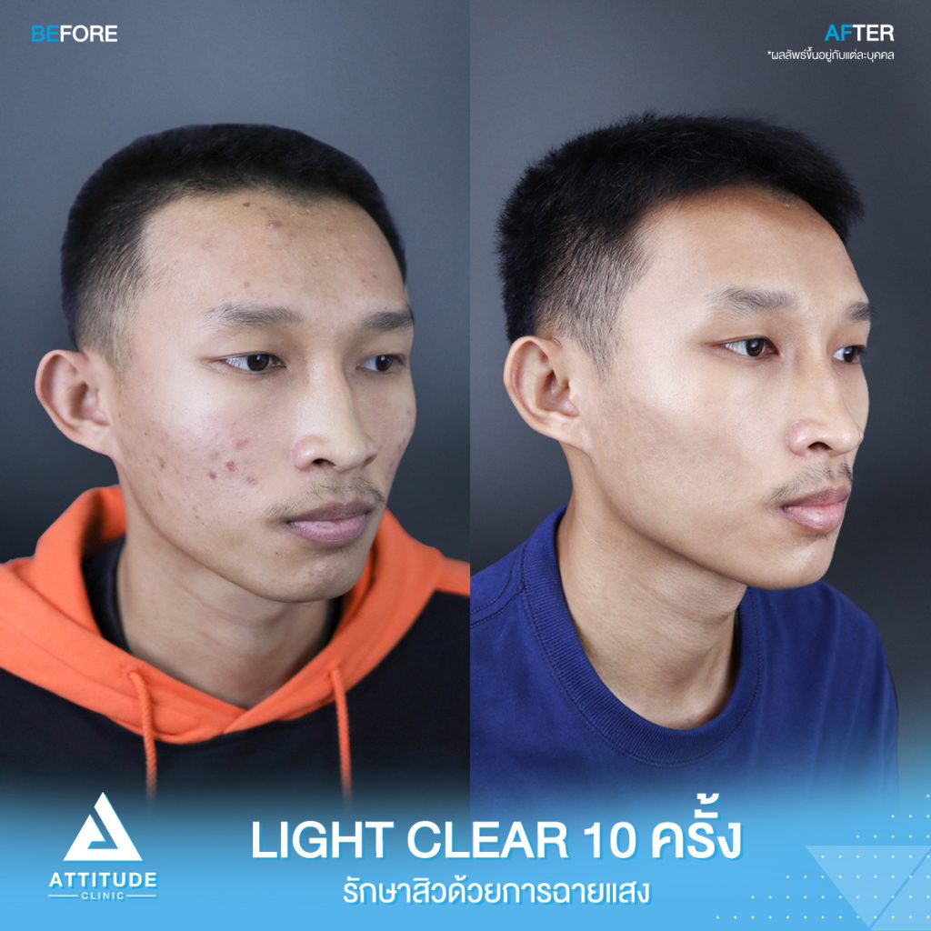 เปลี่ยนหน้าสิวเป็นหน้าใส รีวิวรักษาสิวด้วยการฉายแสง โปรแกรม Light Clear 7 ขั้นตอน จำนวน 10 ครั้ง น้องภัครพงษ์ มีปัญหาสิวและรอยสิวจัดเต็ม หลังรักษาสิวตอนนี้หน้าใสขึ้น ผิวเรียบเนียน มั่นใจขึ้นสุดๆ