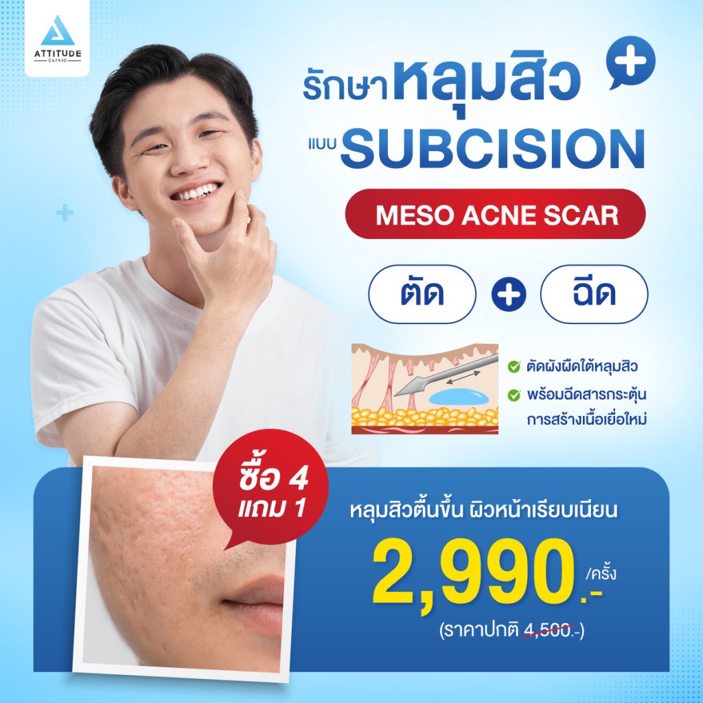 Meso Acne Scar เทคนิครักษาหลุมสิว Subcision ตัดพังผืดใต้หลุมสิว พร้อมฉีดตัวยากระตุ้นสร้างเนื้อเยื่อใหม่ถาวรที่แอททิจูดคลินิก