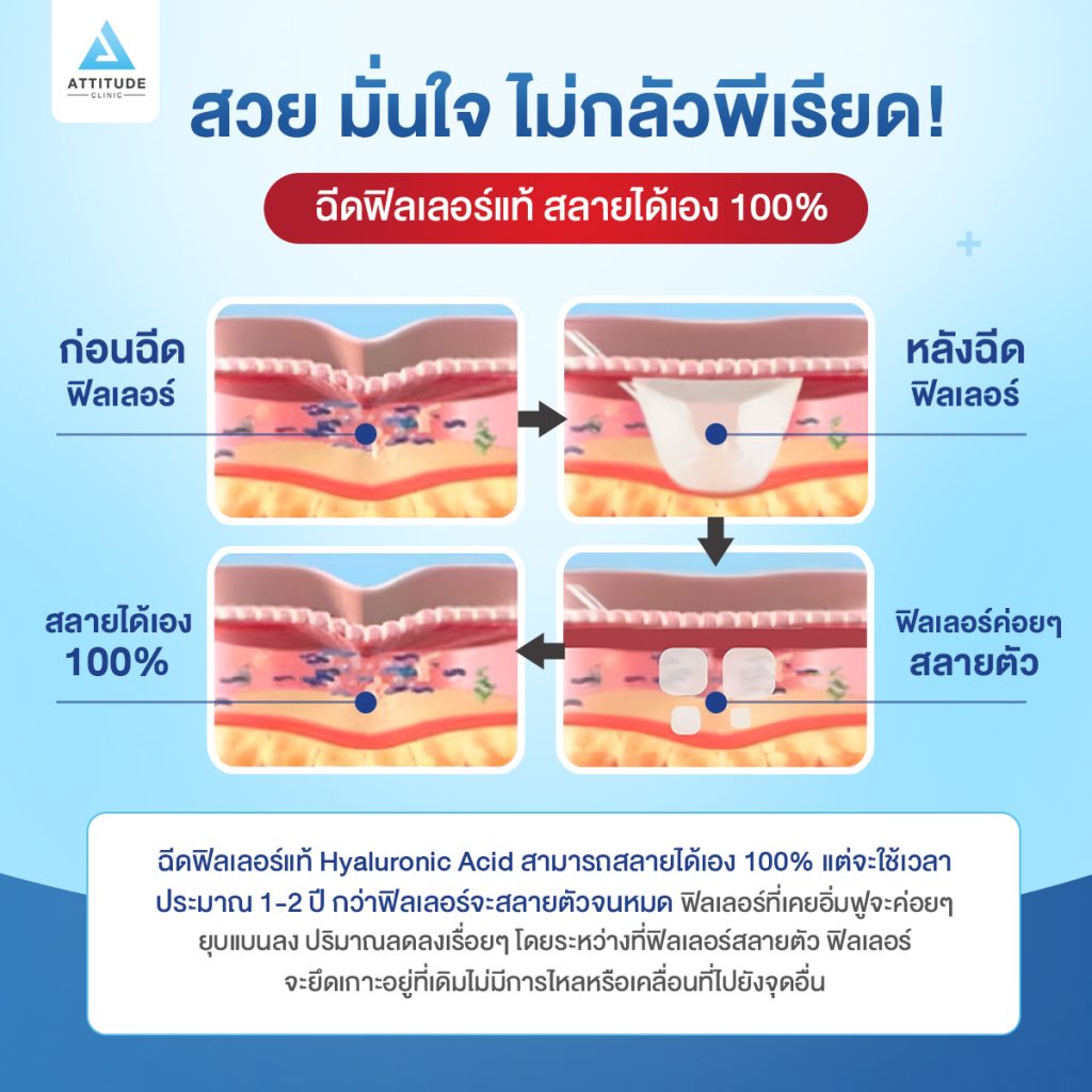 ฉีดฟิลเลอร์แท้ที่แอททิจูดไม่ต้องกลัว ฉีดฟิลเลอร์แท้ที่แอททิจูดไม่ต้องกลัว! หลายคนมีความกังวลฟิลเลอร์ไปแล้วจะตกค้างในร่างกายหรือไม่ ฟิลเลอร์สลายได้เองหรือป่าว? แอททิจูดมาคลายข้อสงสัยให้เอง
