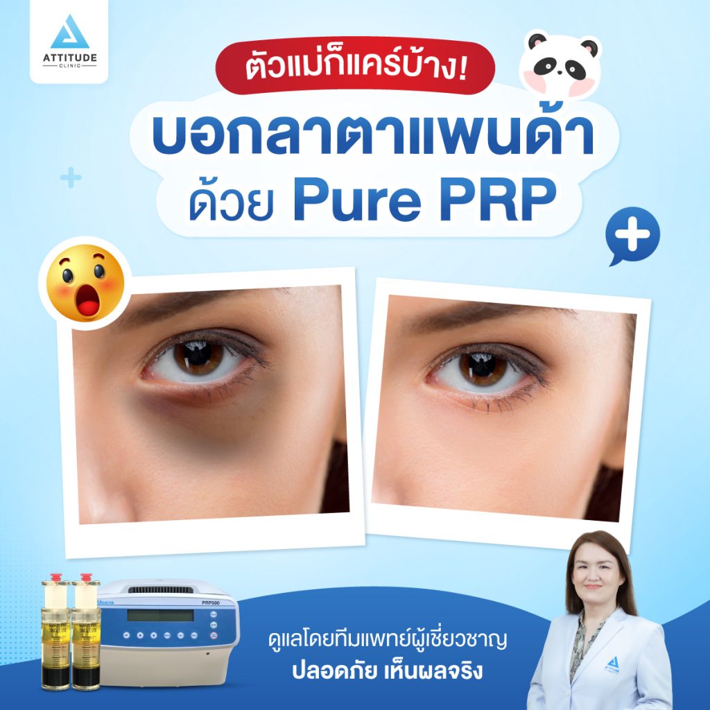 บอกลาตาแพนด้า ด้วย Pure PRP รอยคล้ำใต้ตาให้ใสปิ๊ง