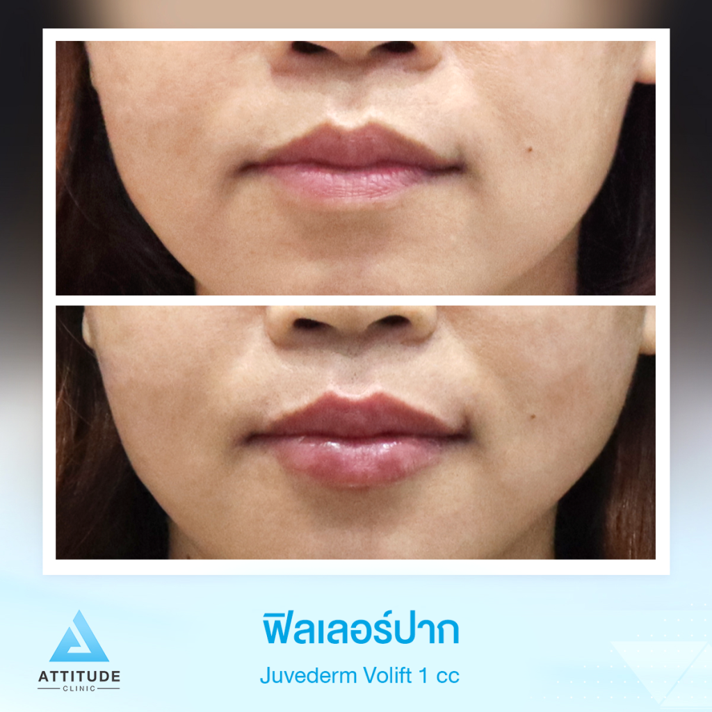 ฟิลเลอร์ปากสวยเป๊ะ รีวิวฉีดฟิลเลอร์ปาก Juvederm Volift จำนวน 1 cc เติมเต็มปากให้อวบอิ่ม สวยปัง น่าจุ๊บ หันมุมไหนก็มั่นใจ ด้วยฟิลเลอร์ที่ออกแบบมาเพื่อฉีดปากโดยเฉพาะ