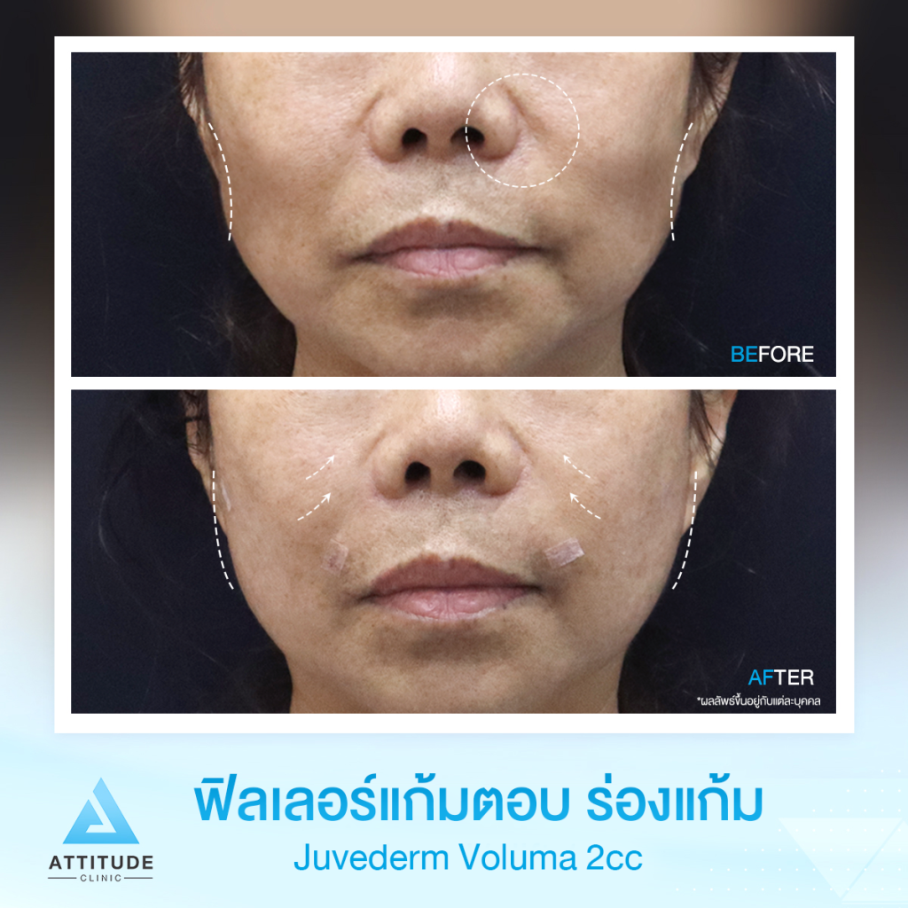 เติมร่องแก้มปรับหน้าเด็ก รีวิวฉีดฟิลเลอร์ร่องแก้ม แก้มตอบ Jeuvederm Voluma จำนวน 2 cc เติมเต็มร่องลึกให้อิ่มฟู หน้าโดยรวมมีมิติมากขึ้น มั่นใจ ด้วยฟิลเลอร์แท้