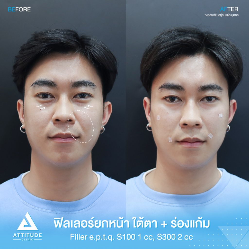 รีวิวฉีดฟิลเลอร์ใต้ตา รีวิวฉีดฟิลเลอร์ใต้ตา ร่องแก้ม ยกหน้า e.p.t.q. S300 จำนวน 2 cc S100 จำนวน 1 cc คุณวราชัย เติมเต็มร่องใต้ตาให้อิ่มฟู แก้ใต้ตาคล้ำ เก็บร่องแก้มลดอายุ ยกหน้าเพิ่มวอลลุ่ม ผลลัพธ์เป็นธรรมชาติ