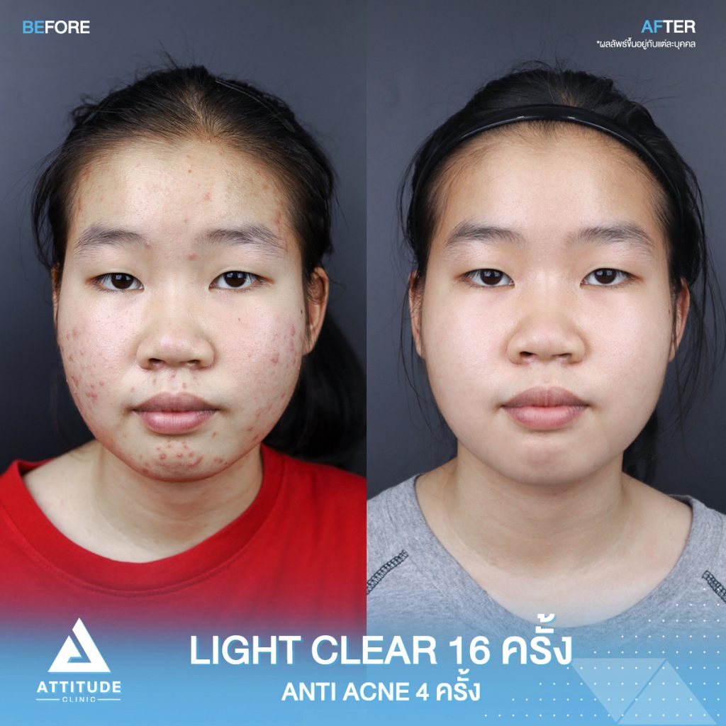 รีวิวรักษาสิวโปรแกรม Light Clear 7 ขั้นตอน จำนวน 16 ครั้ง โปรแกรม Anti Acne เคลียร์สิว 6 ขั้นตอน จำนวน 4 ครั้ง ของน้องณัฐชยา ที่มีปัญหาสิวและรอยสิวจัดเต็ม หลังรักษาตอนนี้หน้าใส ผิวเรียบเนียน