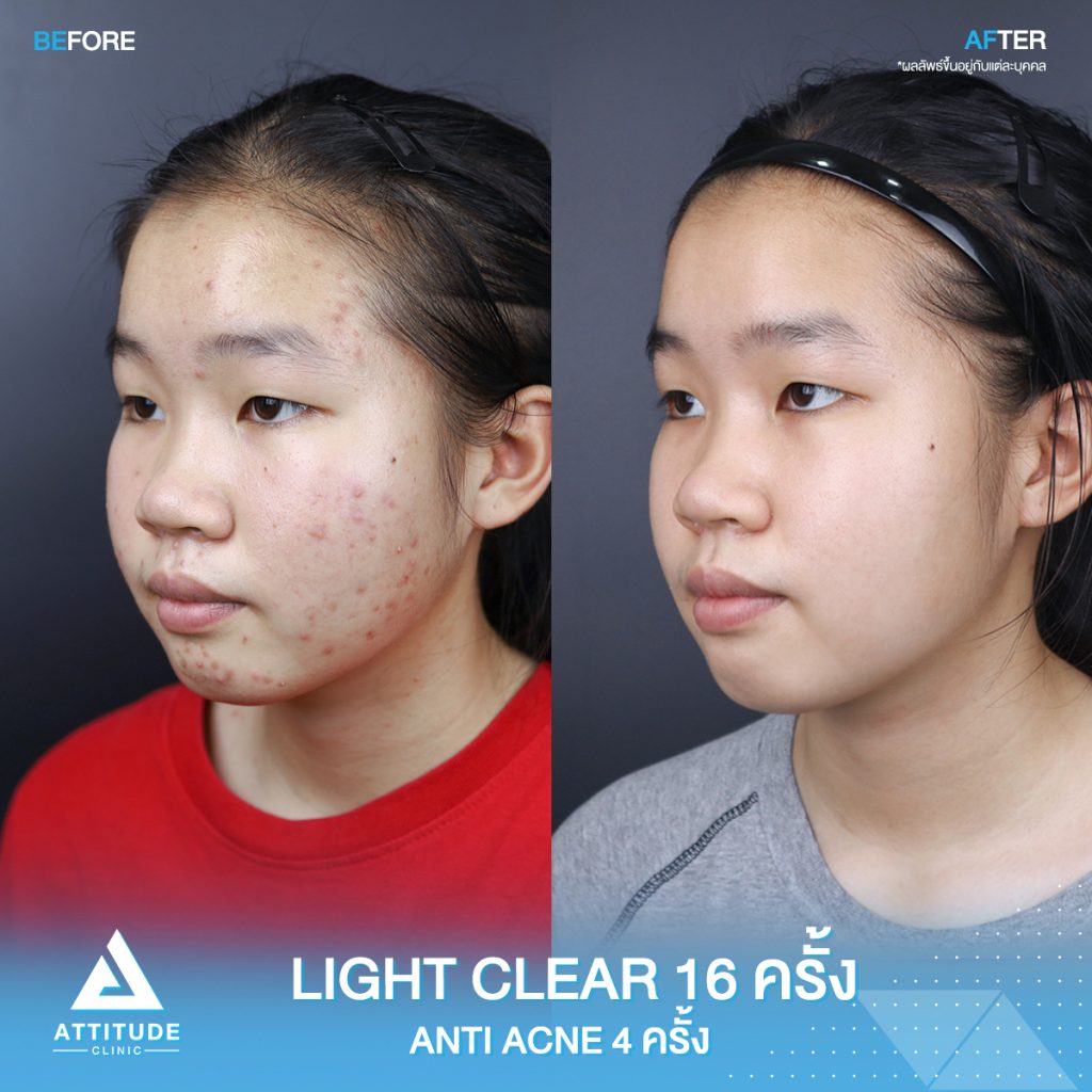 รีวิวรักษาสิวโปรแกรม Light Clear 7 ขั้นตอน จำนวน 16 ครั้ง โปรแกรม Anti Acne เคลียร์สิว 6 ขั้นตอน จำนวน 4 ครั้ง ของน้องณัฐชยา ที่มีปัญหาสิวและรอยสิวจัดเต็ม หลังรักษาตอนนี้หน้าใส ผิวเรียบเนียน