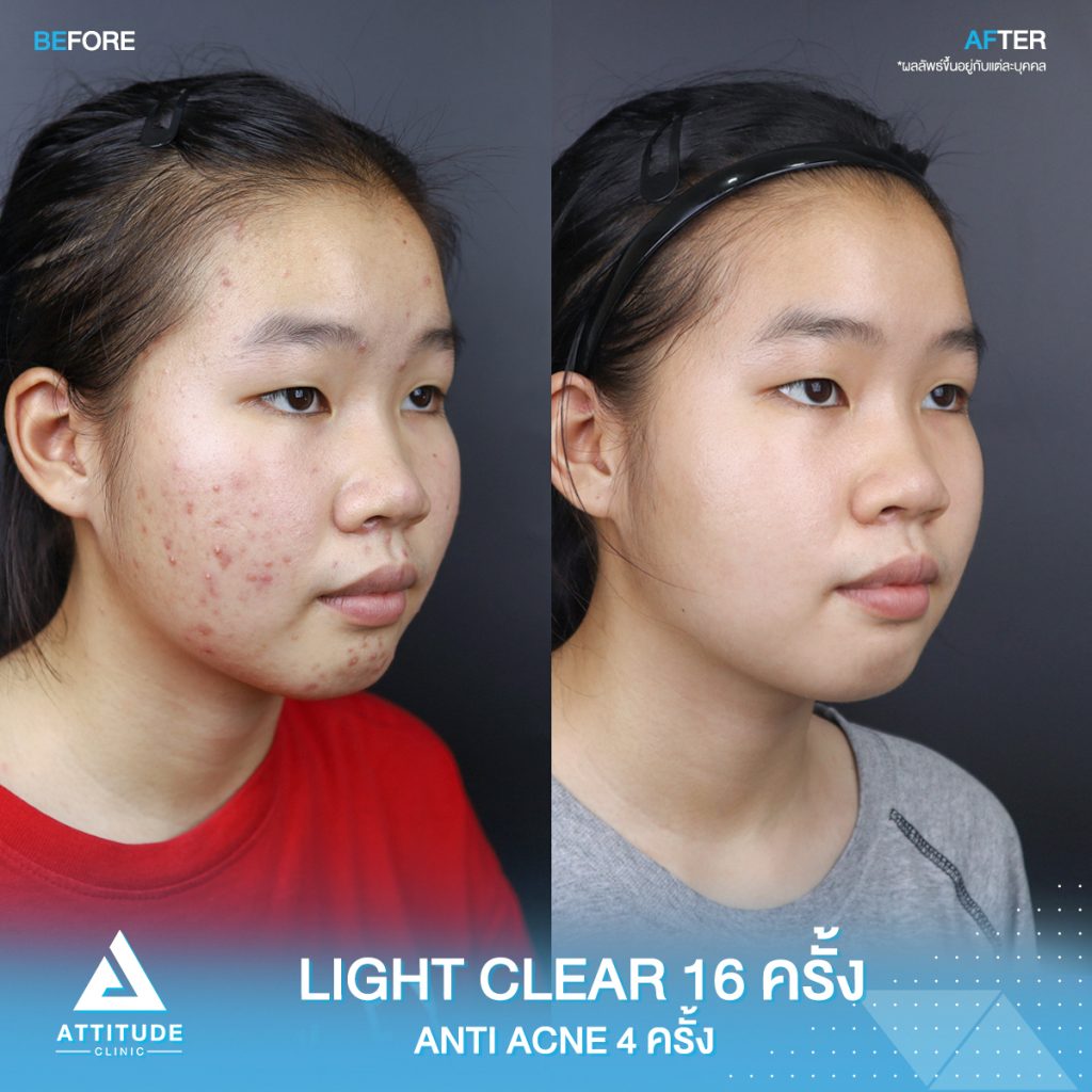 รีวิวรักษาสิวโปรแกรม Light Clear 7 ขั้นตอน จำนวน 16 ครั้ง โปรแกรม Anti Acne เคลียร์สิว 6 ขั้นตอน จำนวน 4 ครั้ง ของน้องณัฐชยา ที่มีปัญหาสิวและรอยสิวจัดเต็ม หลังรักษาตอนนี้หน้าใส ผิวเรียบเนียน