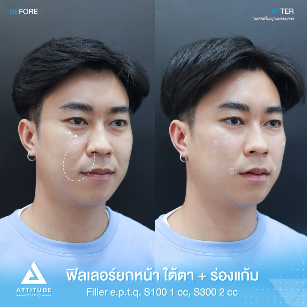 รีวิวฉีดฟิลเลอร์ใต้าตา ร่องแก้ม ยกหน้า e.p.t.q. S300 จำนวน 2 cc S100 จำนวน 1 cc คุณวราชัย เติมเต็มร่องใต้ตาให้อิ่มฟู แก้ใต้ตาคล้ำ เก็บร่องแก้มลดอายุ ยกหน้าเพิ่มวอลลุ่ม ผลลัพธ์เป็นธรรมชาติ