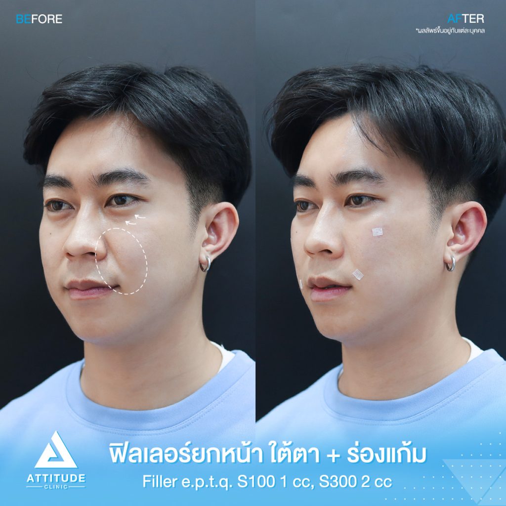 รีวิวฉีดฟิลเลอร์ใต้าตา ร่องแก้ม ยกหน้า e.p.t.q. S300 จำนวน 2 cc S100 จำนวน 1 cc คุณวราชัย เติมเต็มร่องใต้ตาให้อิ่มฟู แก้ใต้ตาคล้ำ เก็บร่องแก้มลดอายุ ยกหน้าเพิ่มวอลลุ่ม ผลลัพธ์เป็นธรรมชาติ