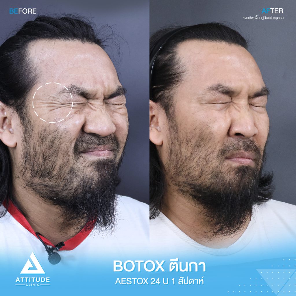 พี่เมย์ ดูโอเมย์ เจ้าของเพลงฮิต "เมาทุกขวดเจ็บปวดทุกเพลง" ก็มาฉีด Botox Aestox เพื่อลดริ้วรอย ให้หน้าดูเด็กลง ที่ Attitude Clinic