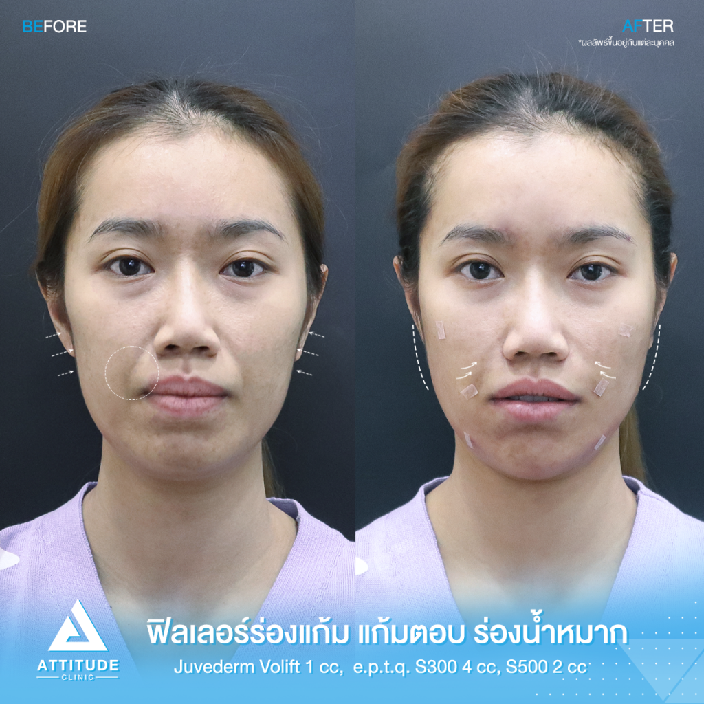 รีวิวฉีดฟิลเลอร์ ร่องแก้ม แก้มตอบ ร่องน้ำหมาก Juvederm Volift 1 cc e.p.t.q. S300 4cc e.p.t.q. S500 2cc รวม 7 cc ของคุณสุธัญญา เติมเต็มทุกร่องลึกให้เต็มอิ่ม เพิ่มวอลลุ่ม ผลลัพธ์เป็นธรรมชาติ