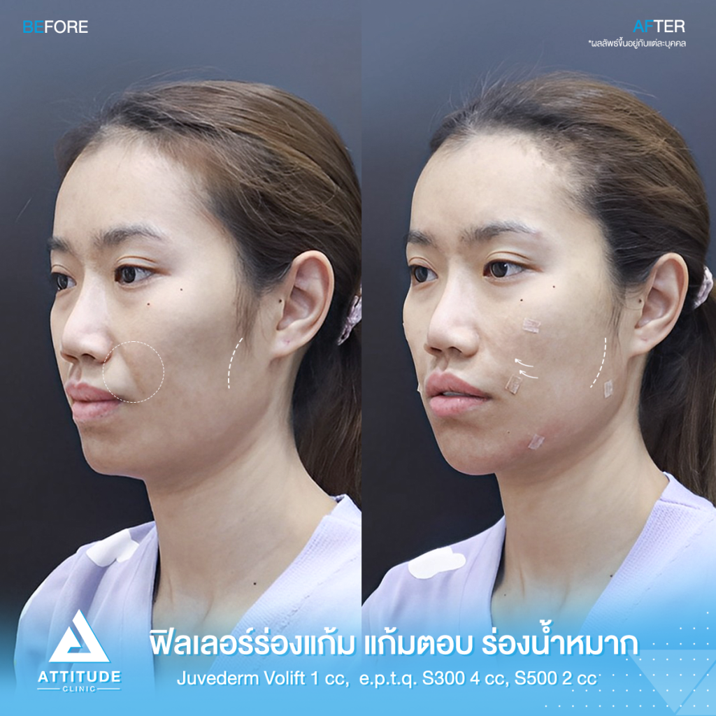 รีวิวฉีดฟิลเลอร์ ร่องแก้ม แก้มตอบ ร่องน้ำหมาก Juvederm Volift 1 cc e.p.t.q. S300 4cc e.p.t.q. S500 2cc รวม 7 cc ของคุณสุธัญญา เติมเต็มทุกร่องลึกให้เต็มอิ่ม เพิ่มวอลลุ่ม ผลลัพธ์เป็นธรรมชาติ