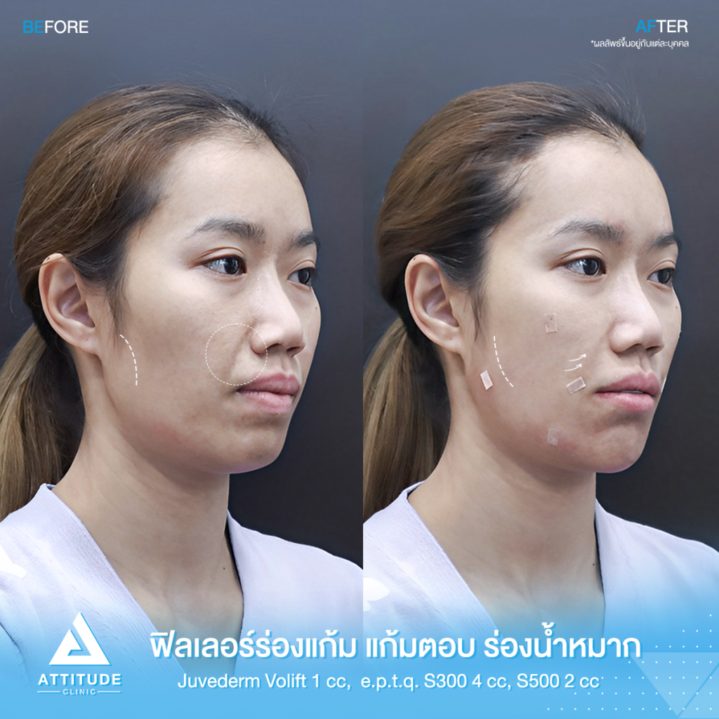 รีวิวฉีดฟิลเลอร์ ร่องแก้ม แก้มตอบ ร่องน้ำหมาก Juvederm Volift 1 cc e.p.t.q. S300 4cc e.p.t.q. S500 2cc รวม 7 cc ของคุณสุธัญญา เติมเต็มทุกร่องลึกให้เต็มอิ่ม เพิ่มวอลลุ่ม ผลลัพธ์เป็นธรรมชาติ