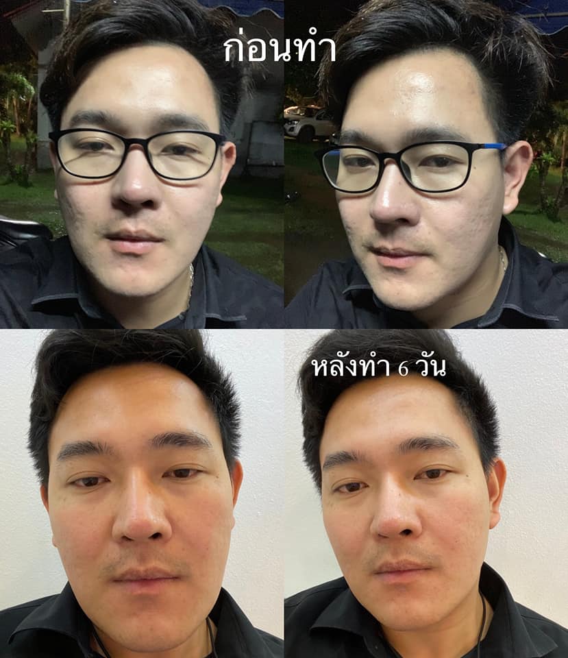 Discovery Pico ฮิตเป็นกระแสที่สุดตอนนี้ เครื่องแท้จากอิตาลี รักษาหลุมสิว รีจูหน้าใส กระชับรูขุมขน เห็นผลเปลี่ยนแปลงหลังทำชัดเจน! ดูแลโดยแพทย์ผู้ชำนาญการ ที่ Attitude Clinic ห้วยขวาง