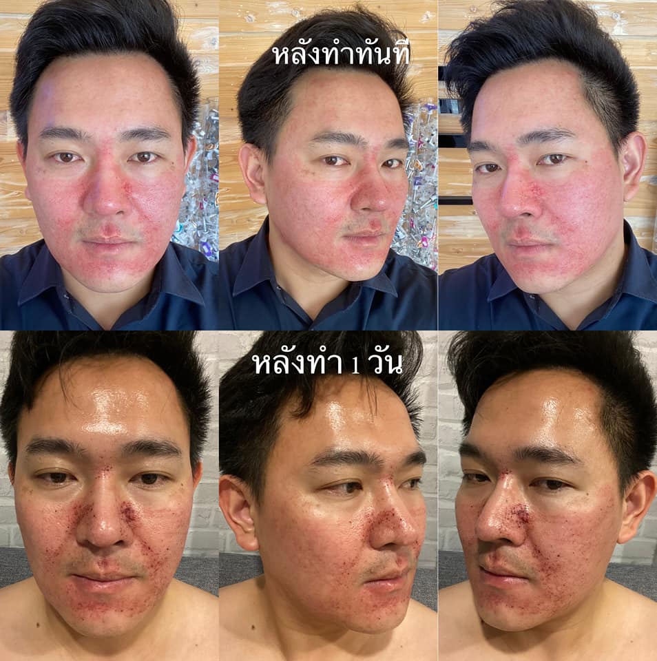 Discovery Pico ฮิตเป็นกระแสที่สุดตอนนี้ เครื่องแท้จากอิตาลี รักษาหลุมสิว รีจูหน้าใส กระชับรูขุมขน เห็นผลเปลี่ยนแปลงหลังทำชัดเจน! ดูแลโดยแพทย์ผู้ชำนาญการ ที่ Attitude Clinic ห้วยขวาง