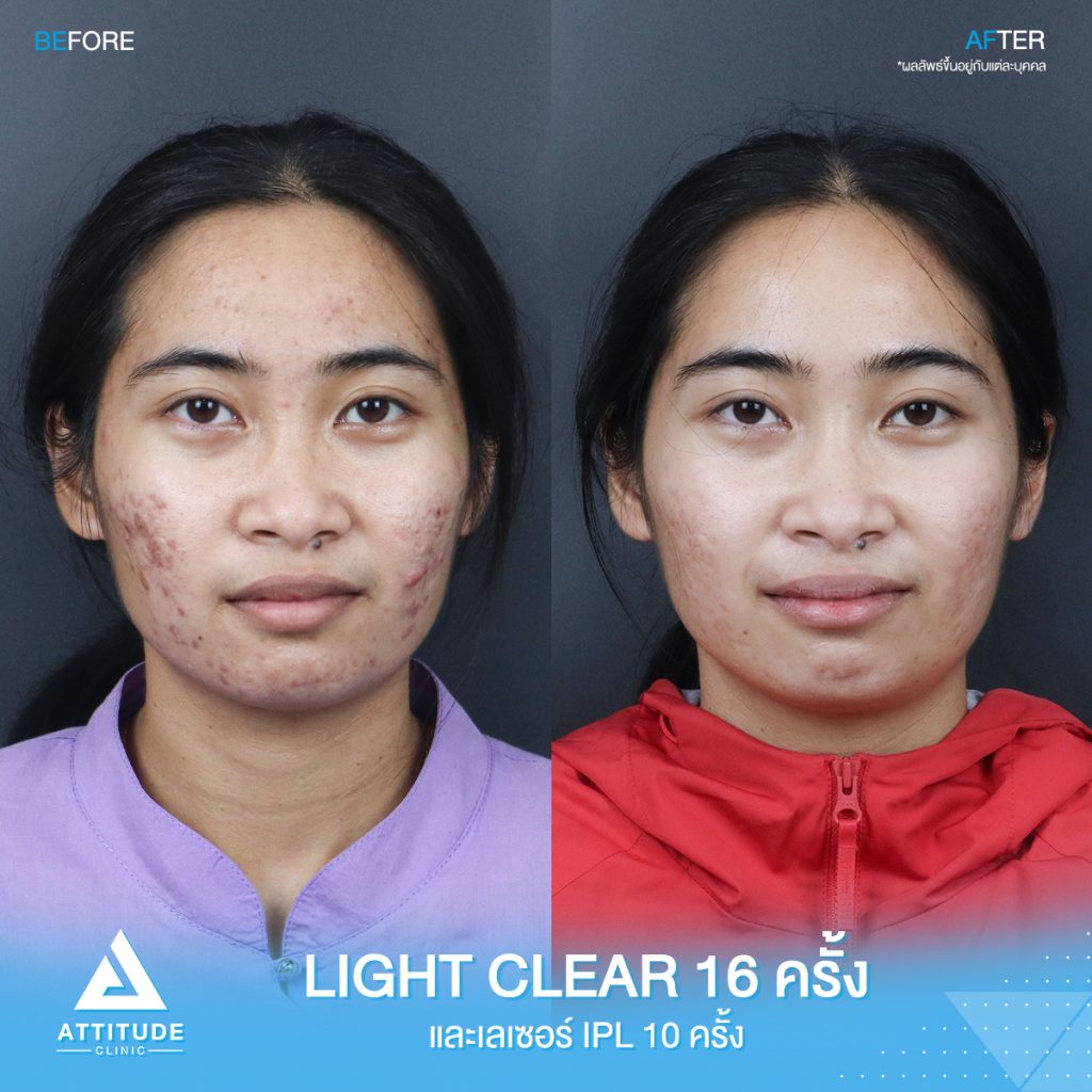 รีวิวรักษาสิว ด้วยการฉายแสง Light Clear 7 ขั้นตอน จำนวน 16 ครั้ง เลเซอร์หน้าใส Cellec V IPL จำนวน 10 ครั้ง ของคุณกิ๊ก ที่มีปัญหาสิวและรอยสิวจัดเต็ม หลังรักษาตอนนี้หน้าใส ไร้สิว มั่นใจขึ้นสุดๆ