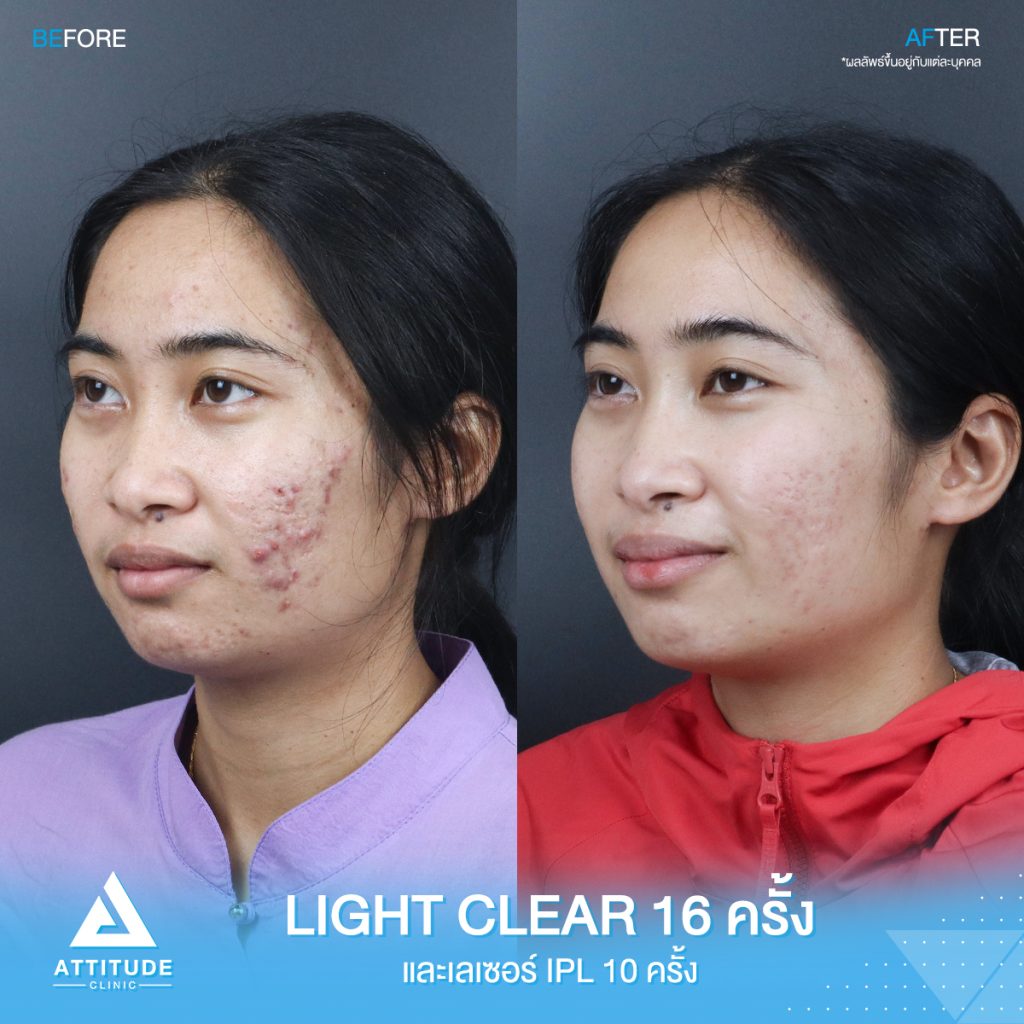 รีวิวรักษาสิว ด้วยการฉายแสง Light Clear 7 ขั้นตอน จำนวน 16 ครั้ง เลเซอร์หน้าใส Cellec V IPL จำนวน 10 ครั้ง ของคุณกิ๊ก ที่มีปัญหาสิวและรอยสิวจัดเต็ม หลังรักษาตอนนี้หน้าใส ไร้สิว มั่นใจขึ้นสุดๆ