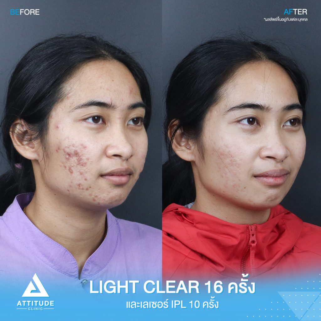 รีวิวรักษาสิว ด้วยการฉายแสง Light Clear 7 ขั้นตอน จำนวน 16 ครั้ง เลเซอร์หน้าใส Cellec V IPL จำนวน 10 ครั้ง ของคุณกิ๊ก ที่มีปัญหาสิวและรอยสิวจัดเต็ม หลังรักษาตอนนี้หน้าใส ไร้สิว มั่นใจขึ้นสุดๆ