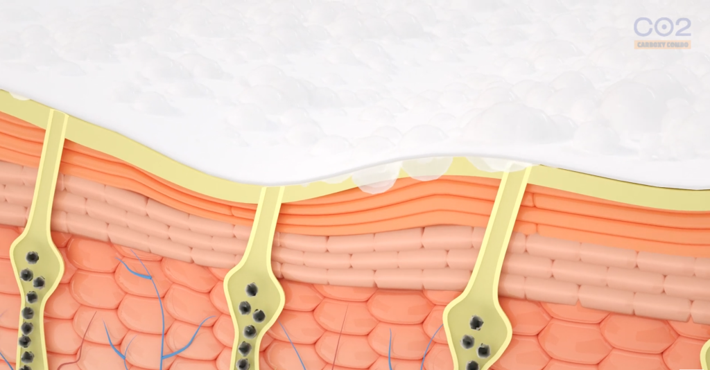 ทำความรู้จัก Carboxy Mask มาสก์นวัตกรรมใหม่! เติมออกซิเจนให้ผิวด้วยคาร์บอนไดออกไซด์ (Co2) ผิวแน่น ตึง กระชับ ปรับผิวกระจ่างใส ไร้รอยกวนใจ
