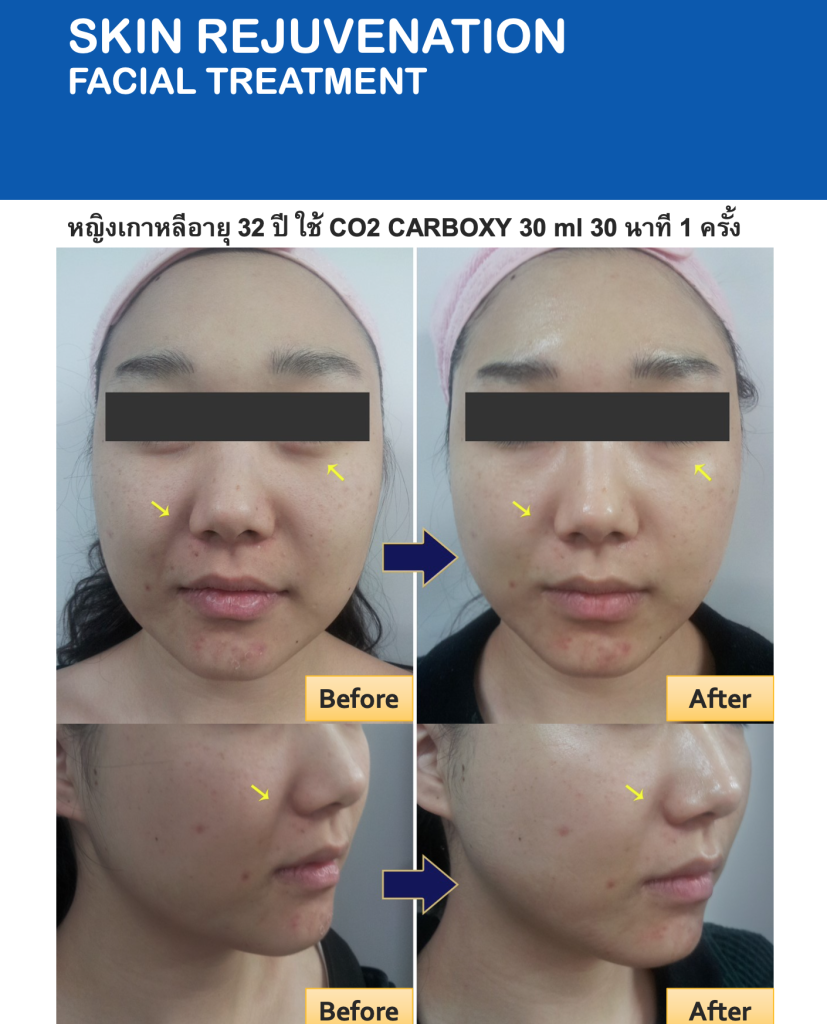 ผลลัพธ์ที่ได้จากการทำ Carboxy Mask