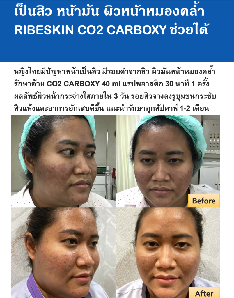 ผลลัพธ์ที่ได้จากการทำ Carboxy Mask