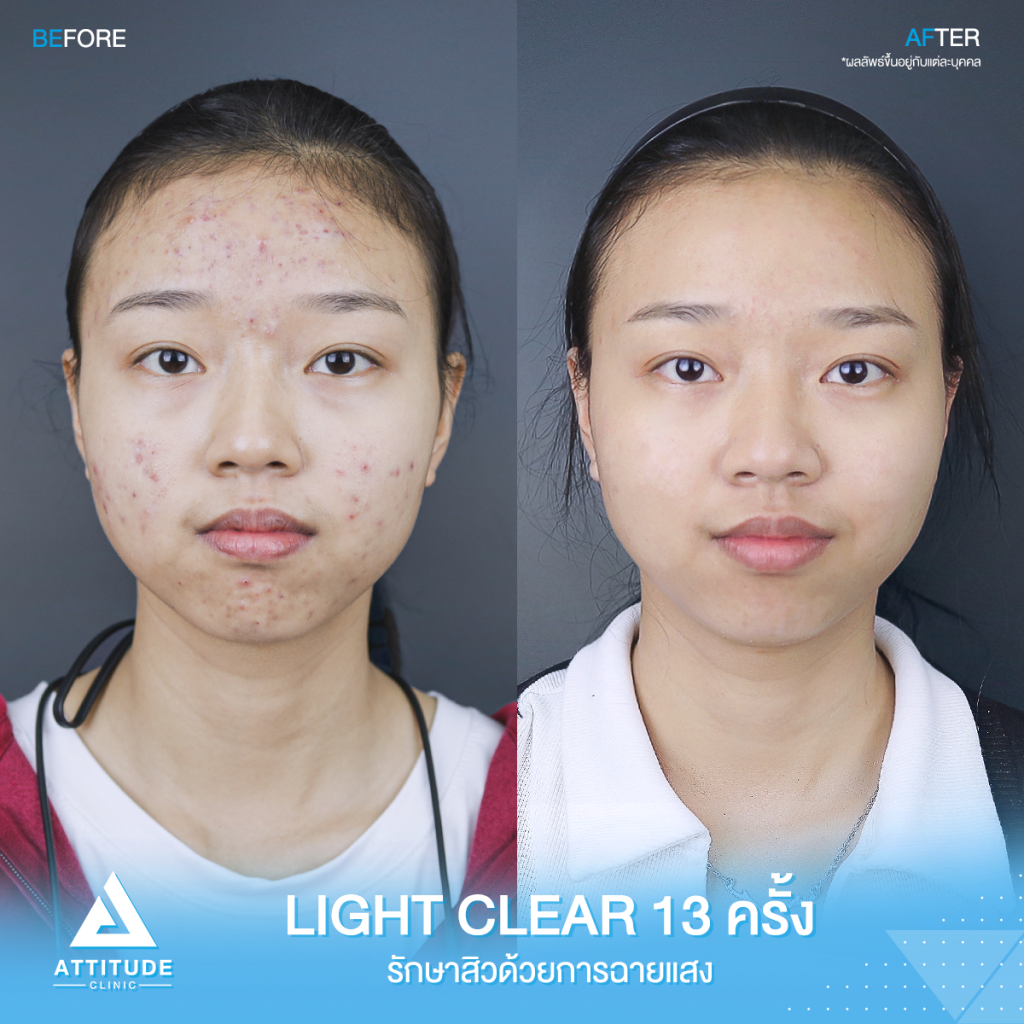 รีวิวรักษาสิว รีวิวรักษาสิว คุณณัฐธิดา ด้วยการฉายแสง Light Clear 7 ขั้นตอน จำนวน 13 ครั้ง ปัญหาสิวและรอยสิวจัดเต็ม หลังรักษาตอนนี้หน้าใส ไร้สิว มั่นใจขึ้นสุดๆ