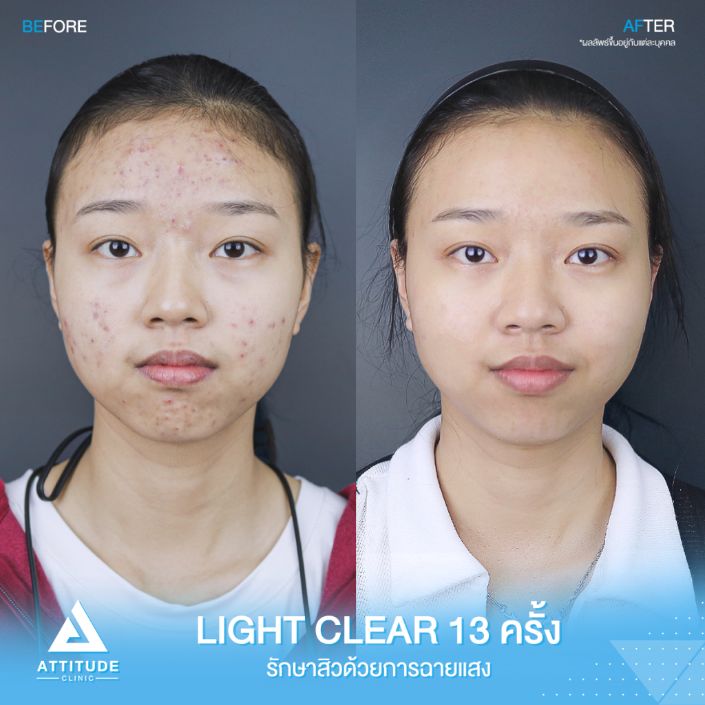 รีวิวรักษาสิว คุณณัฐธิดา ด้วยการฉายแสง Light Clear 7 ขั้นตอน จำนวน 13 ครั้ง ปัญหาสิวและรอยสิวจัดเต็ม หลังรักษาตอนนี้หน้าใส ไร้สิว มั่นใจขึ้นสุดๆ