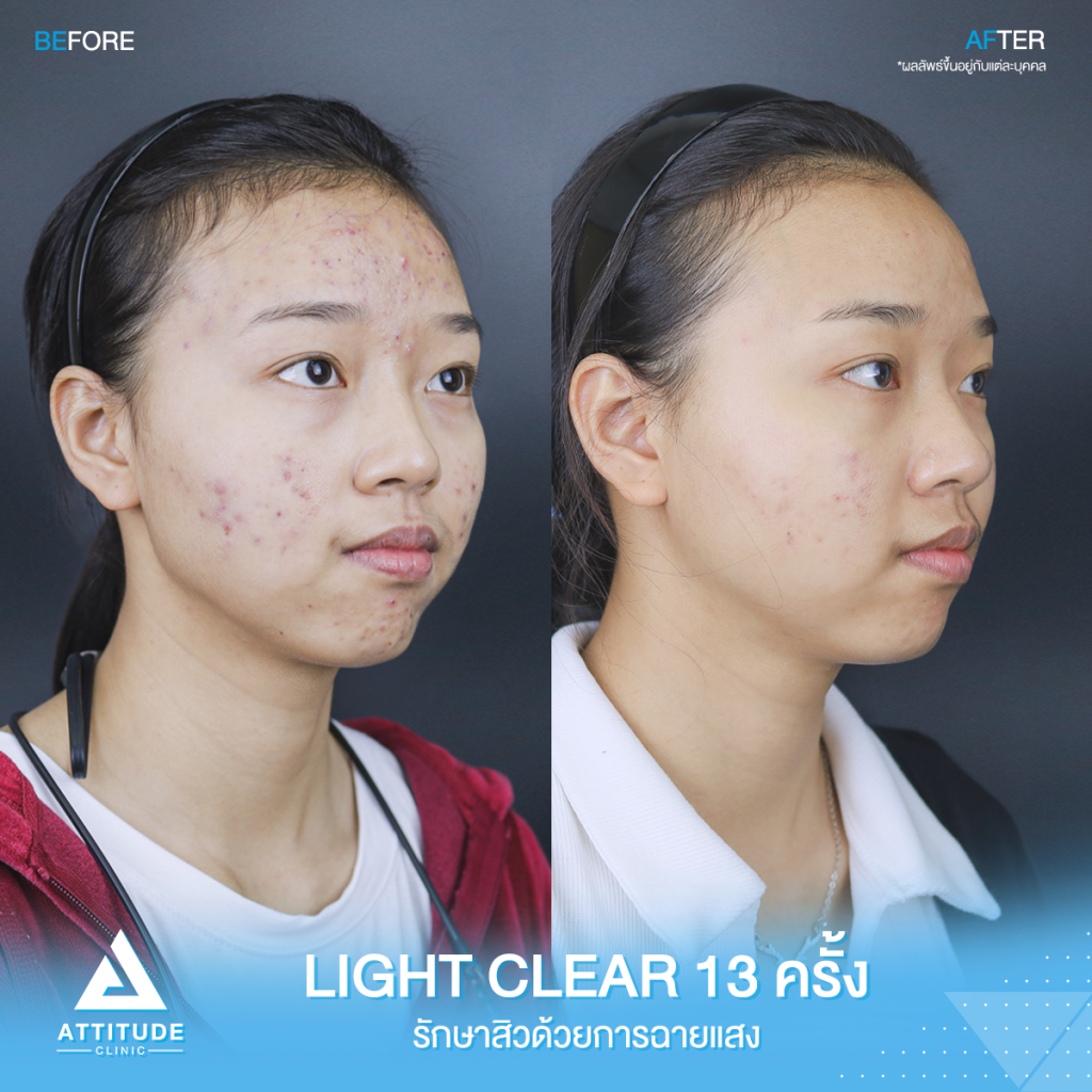 รีวิวรักษาสิว คุณณัฐธิดา ด้วยการฉายแสง Light Clear 7 ขั้นตอน จำนวน 13 ครั้ง ปัญหาสิวและรอยสิวจัดเต็ม หลังรักษาตอนนี้หน้าใส ไร้สิว มั่นใจขึ้นสุดๆ