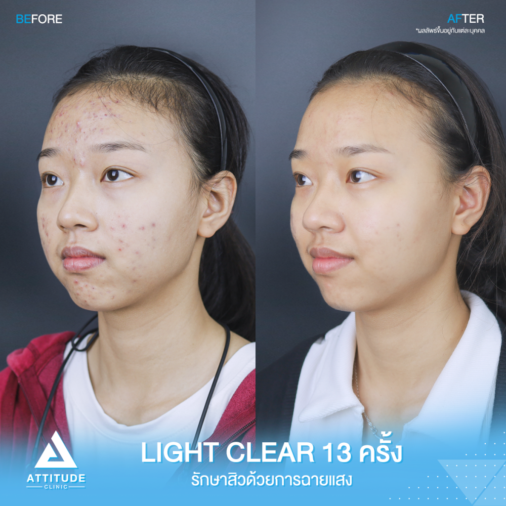 รีวิวรักษาสิว รีวิวรักษาสิว คุณณัฐธิดา ด้วยการฉายแสง Light Clear 7 ขั้นตอน จำนวน 13 ครั้ง ปัญหาสิวและรอยสิวจัดเต็ม หลังรักษาตอนนี้หน้าใส ไร้สิว มั่นใจขึ้นสุดๆ