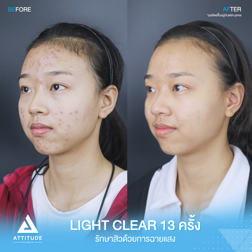 รีวิวรักษาสิว คุณณัฐธิดา ด้วยการฉายแสง Light Clear 7 ขั้นตอน จำนวน 13 ครั้ง ปัญหาสิวและรอยสิวจัดเต็ม หลังรักษาตอนนี้หน้าใส ไร้สิว มั่นใจขึ้นสุดๆ