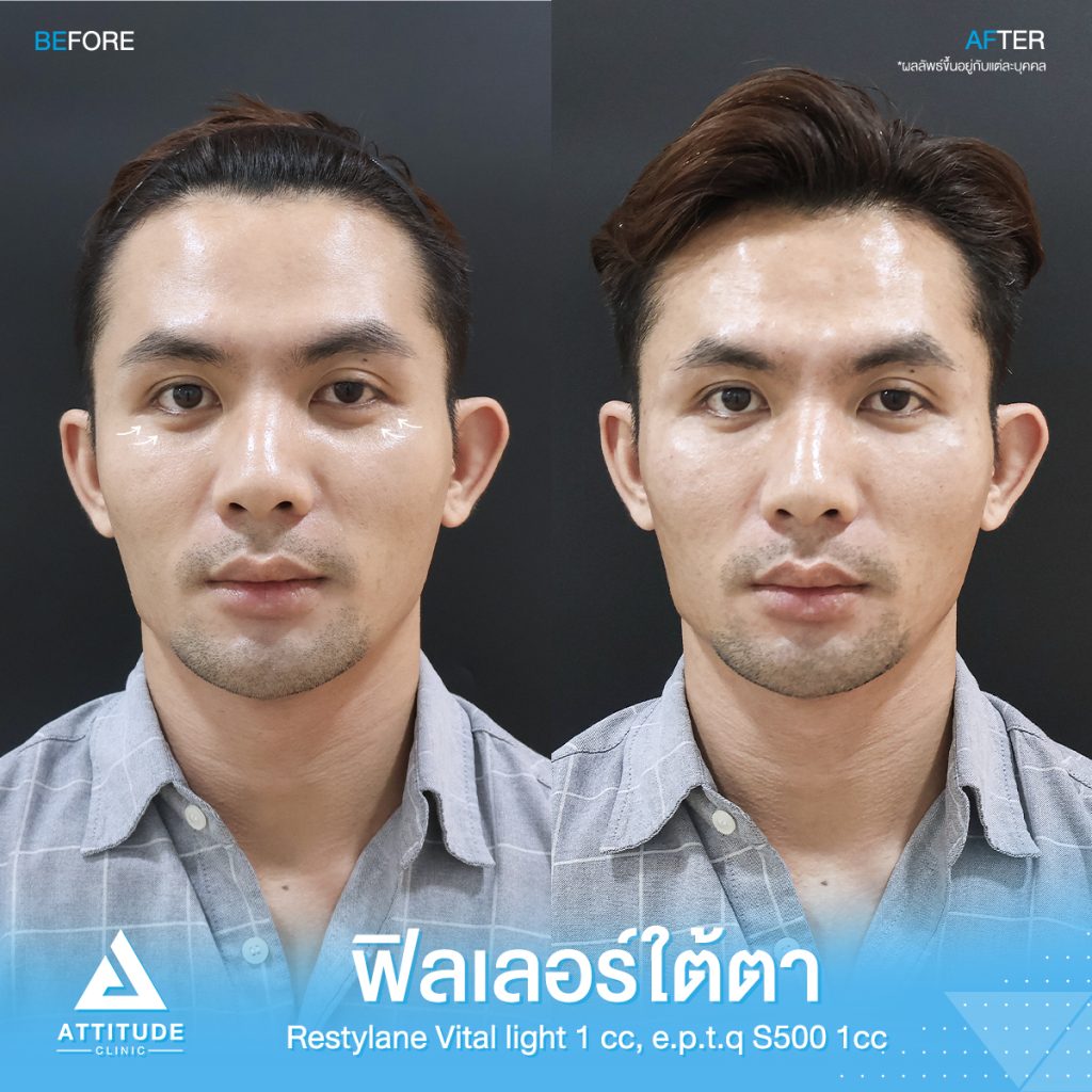 รีวิวฉีดฟิลเลอร์ใต้ตา รีวิวฉีดฟิลเลอร์ใต้ตา Restylane Vital Light จำนวน 1 cc และ e.p.t.q. S500 จำนวน 1 cc รวม 2 cc ของคุณโย เติมเต็มร่องใต้ตาให้อิ่มฟู แก้ใต้ตาคล้ำ ปรับหน้าโทรมให้สดใส