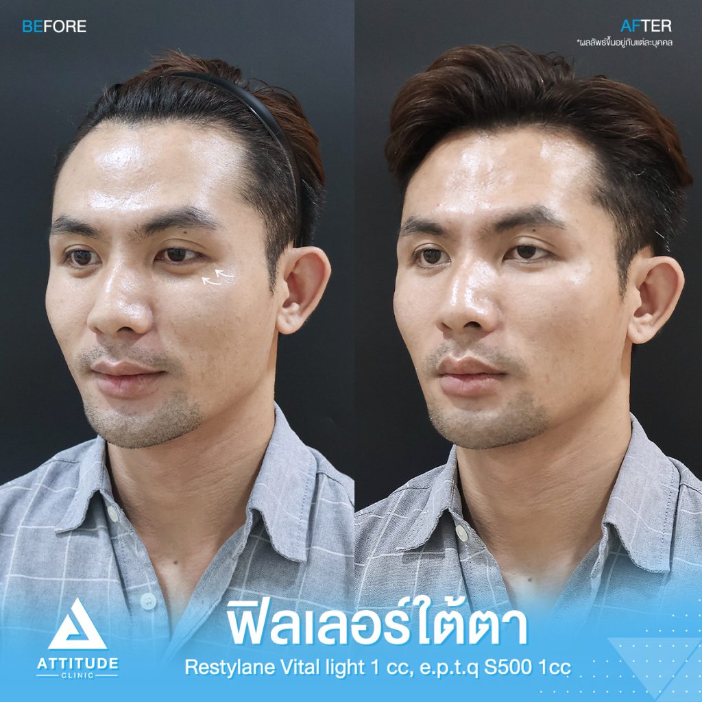 รีวิวฉีดฟิลเลอร์ใต้ตา Restylane Vital Light จำนวน 1 cc และ e.p.t.q. S500 จำนวน 1 cc รวม 2 cc ของคุณโย เติมเต็มร่องใต้ตาให้อิ่มฟู แก้ใต้ตาคล้ำ ปรับหน้าโทรมให้สดใส