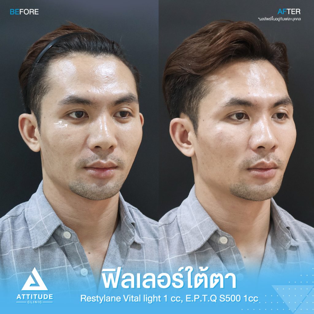 รีวิวฉีดฟิลเลอร์ใต้ตา Restylane Vital Light จำนวน 1 cc และ e.p.t.q. S500 จำนวน 1 cc รวม 2 cc ของคุณโย เติมเต็มร่องใต้ตาให้อิ่มฟู แก้ใต้ตาคล้ำ ปรับหน้าโทรมให้สดใส