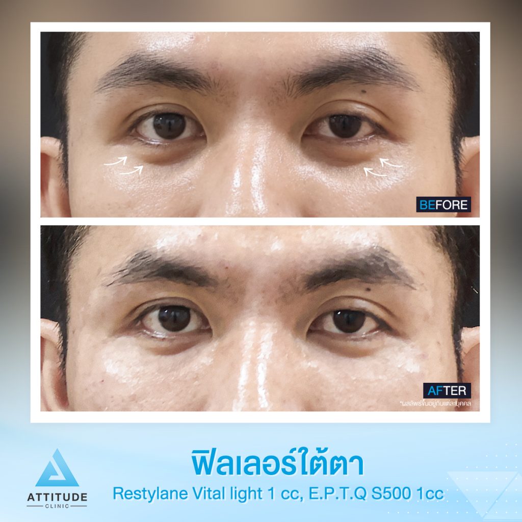 รีวิวฉีดฟิลเลอร์ใต้ตา Restylane Vital Light จำนวน 1 cc และ e.p.t.q. S500 จำนวน 1 cc รวม 2 cc ของคุณโย เติมเต็มร่องใต้ตาให้อิ่มฟู แก้ใต้ตาคล้ำ ปรับหน้าโทรมให้สดใส