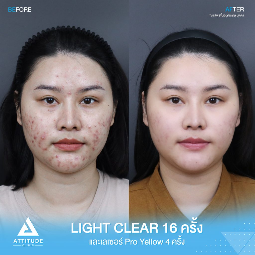 รีวิวรักษาสิว น้องนิว โปรแกรม Light Clear 7 ขั้นตอน จำนวน 16 ครั้ง เลเซอร์ลดรอยแดงสิว Pro Yellow จำนวน 4 ครั้ง สิว รอยสิวจัดเต็ม หลังรักษาหน้าใสขึ้น ผิวเรียบเนียนขึ้น มั่นใจขึ้นสุดๆ