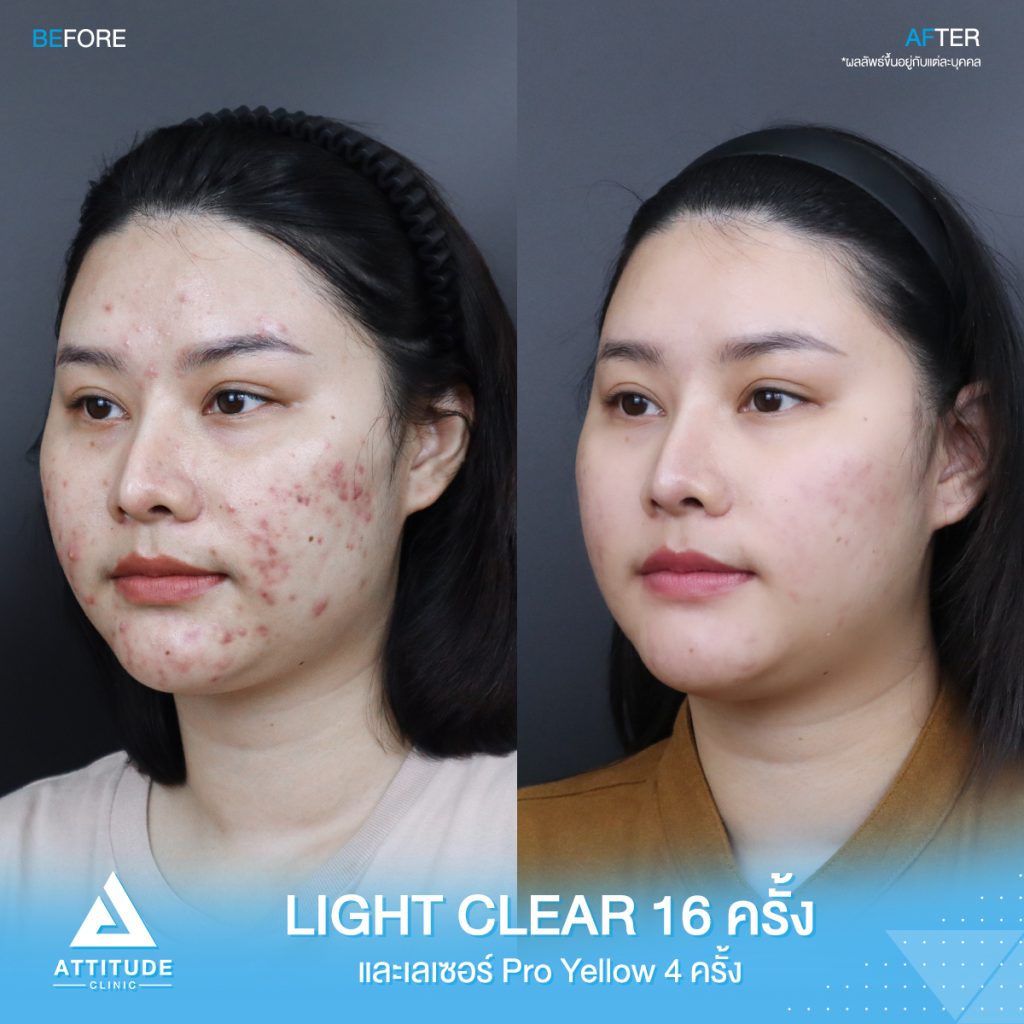 รีวิวรักษาสิว น้องนิว โปรแกรม Light Clear 7 ขั้นตอน จำนวน 16 ครั้ง เลเซอร์ลดรอยแดงสิว Pro Yellow จำนวน 4 ครั้ง สิว รอยสิวจัดเต็ม หลังรักษาหน้าใสขึ้น ผิวเรียบเนียนขึ้น มั่นใจขึ้นสุดๆ