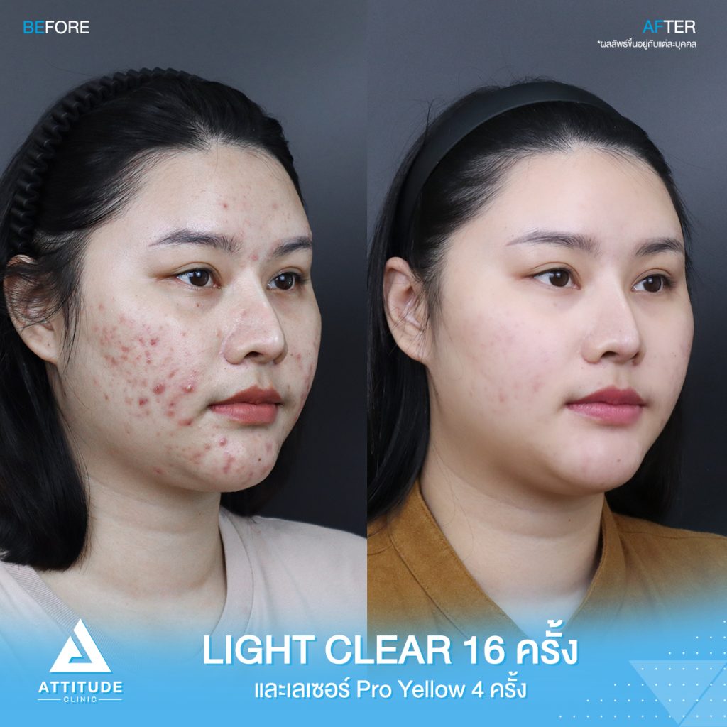 รีวิวรักษาสิว น้องนิว โปรแกรม Light Clear 7 ขั้นตอน จำนวน 16 ครั้ง เลเซอร์ลดรอยแดงสิว Pro Yellow จำนวน 4 ครั้ง สิว รอยสิวจัดเต็ม หลังรักษาหน้าใสขึ้น ผิวเรียบเนียนขึ้น มั่นใจขึ้นสุดๆ