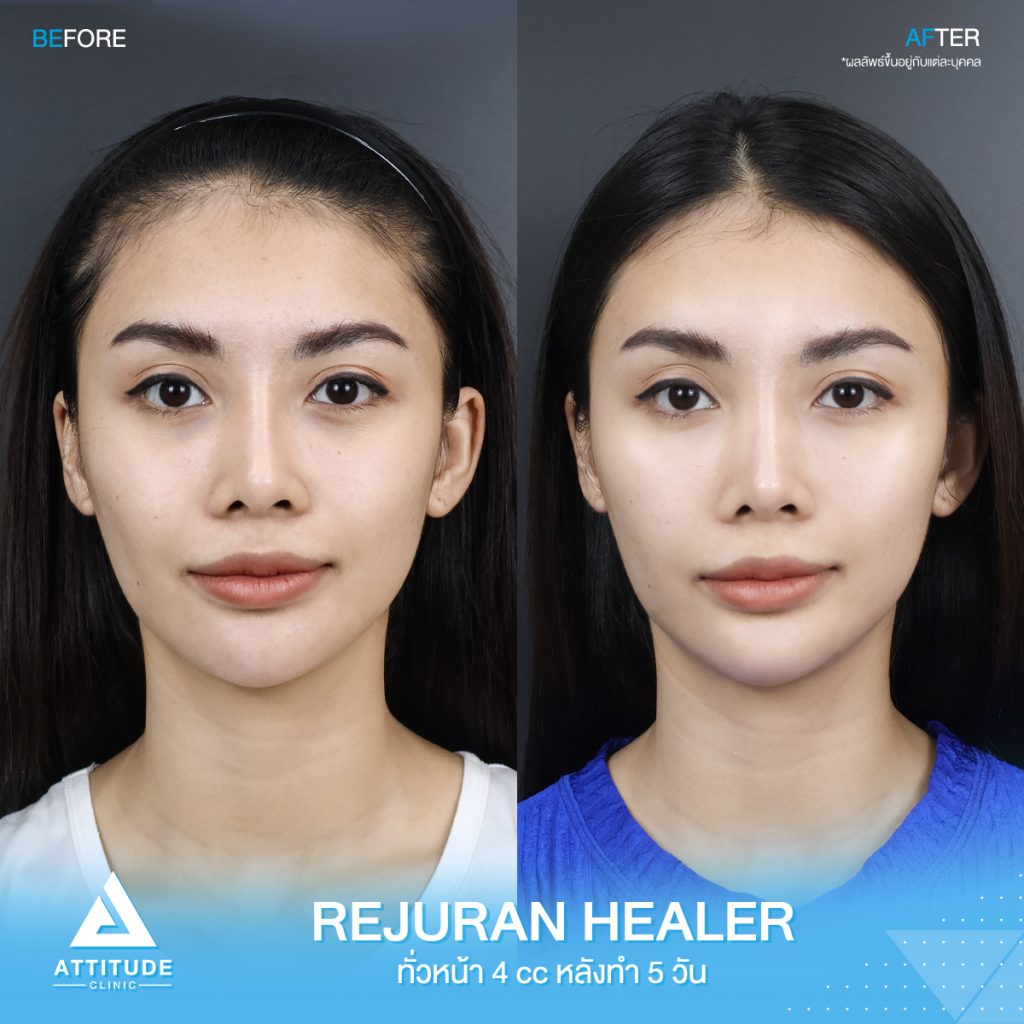 รีวิวฉีด Rejuran Healer ทั่วใบหน้าจำนวน 4 cc อัพเดตหลังทำ 5 วัน ของคุณชมพู มิสแกรนด์เชียงใหม่ 2022 ปรับผิวใส อิ่มฟู ฉ่ำวาว ขาวกระจ่างใส สุขภาพดี ที่แอททิจูดคลินิก