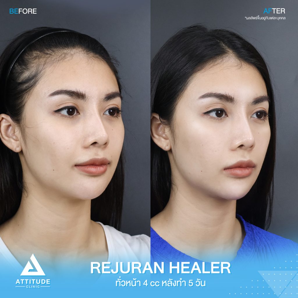 รีวิวฉีด Rejuran Healer ทั่วใบหน้าจำนวน 4 cc อัพเดตหลังทำ 5 วัน ของคุณชมพู มิสแกรนด์เชียงใหม่ 2022 ปรับผิวใส อิ่มฟู ฉ่ำวาว ขาวกระจ่างใส สุขภาพดี ที่แอททิจูดคลินิก