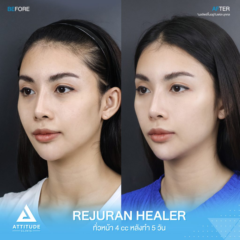 รีวิวฉีด Rejuran Healer ทั่วใบหน้าจำนวน 4 cc อัพเดตหลังทำ 5 วัน ของคุณชมพู มิสแกรนด์เชียงใหม่ 2022 ปรับผิวใส อิ่มฟู ฉ่ำวาว ขาวกระจ่างใส สุขภาพดี ที่แอททิจูดคลินิก