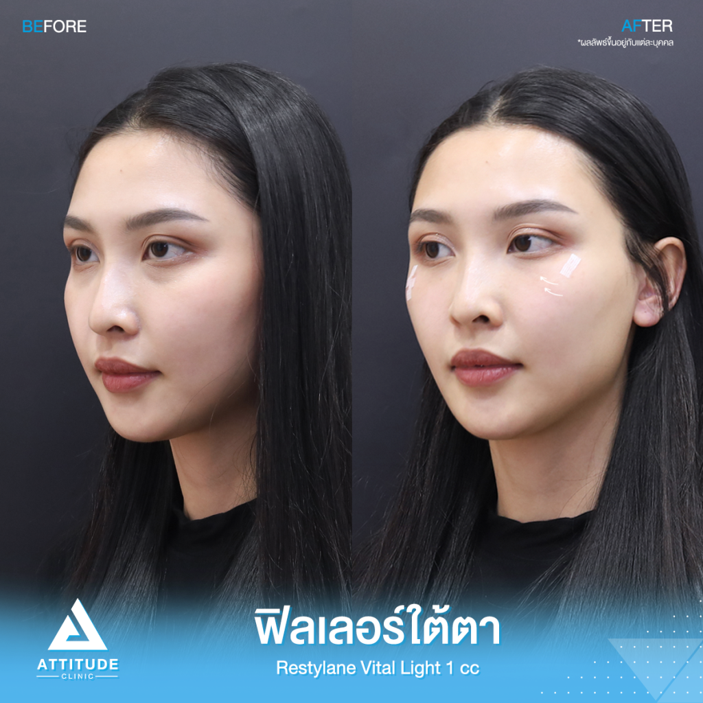 รีวิวฉีดฟิลเลอร์ใต้ตา รีวิวฉีดฟิลเลอร์ใต้ตา Restylane Vital Light จำนวน 1 cc ของน้องดิ้ง เติมเต็มร่องใต้ตาให้อิ่มฟู แก้ใต้ตาคล้ำ ปรับหน้าโทรมให้สดใส ย้อนวัย