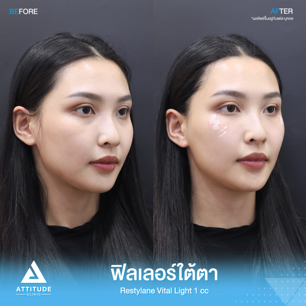 รีวิวฉีดฟิลเลอร์ใต้ตา Restylane Vital Light จำนวน 1 cc ของน้องดิ้ง เติมเต็มร่องใต้ตาให้อิ่มฟู แก้ใต้ตาคล้ำ ปรับหน้าโทรมให้สดใส ย้อนวัย