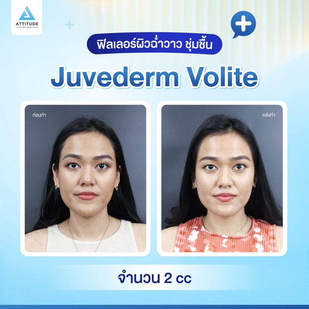 ผลลัพธ์หลังฉีดฟิลเลอร์