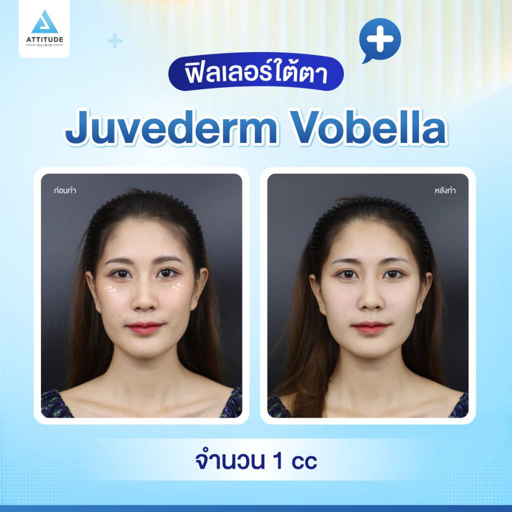 ผลลัพธ์หลังฉีดฟิลเลอร์